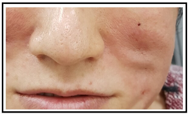 How to Fix Puckering After Thread Lift - Yastrid Medical Aesthetic Supplier