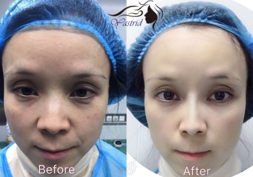 Nose thread lift with Yastrid PCL Nose Thread before after