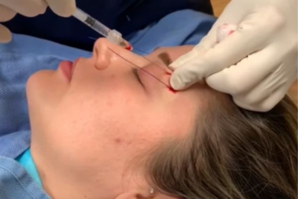 Fox Eye Look with Fox Eye Thread Lift