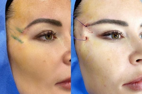 Fox Eye Look with Fox eye surgery