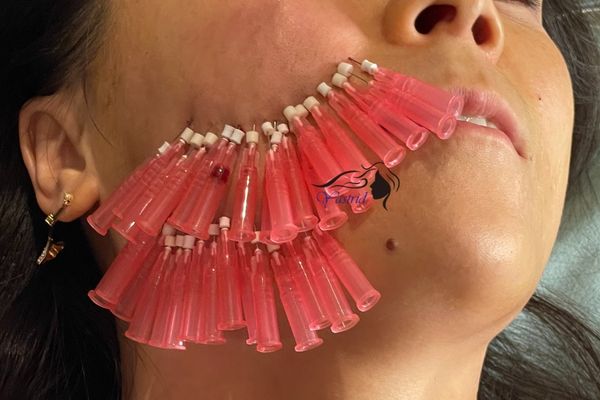 Methods Used by PDO Experts to Create a Youthful Appearance