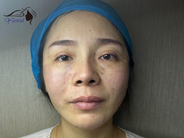 After Cheek Lift and Volume Restoration PDO thread lifts