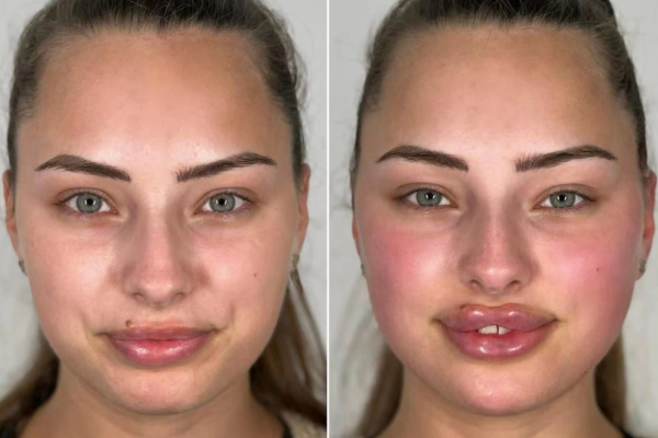 Before and after lip injections