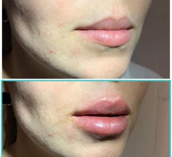 Before and After Lip Injections