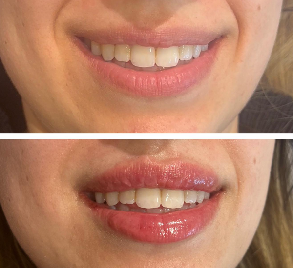 Lip Injections Before And After Pictures
