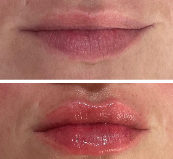 Is 1ml of Lip Filler a Lot