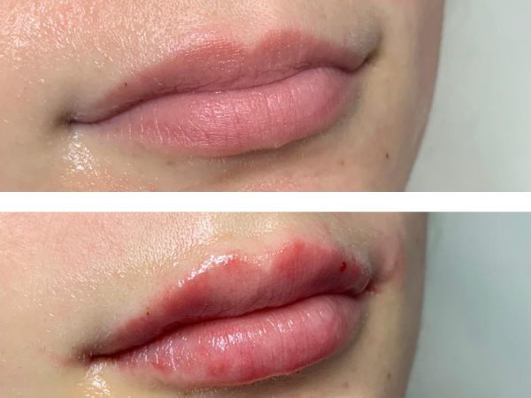 Is 1ml of Lip Filler a Lot