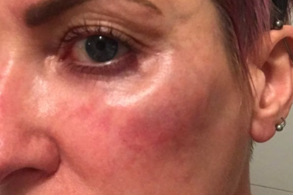 Do Fillers Ruin Your Face? - Yastrid Medical Aesthetic Supplier